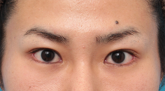 垂れ目（パンダ目）形成（グラマラスライン／下眼瞼下制術）,目尻切開+タレ目形成（グラマラスライン）で目を一回り大きくした男性の症例写真の術前術後画像,After（6ヶ月後）,ba_panda07_b.jpg