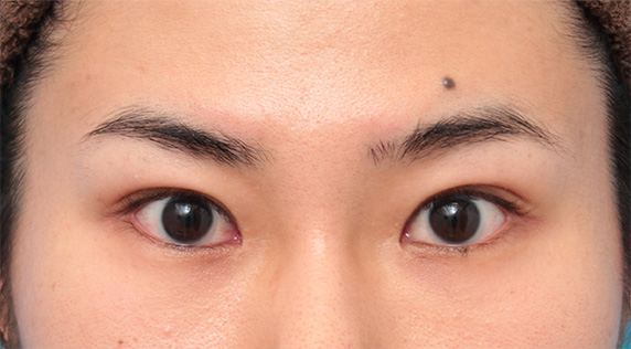 目尻切開,目尻切開+タレ目形成（グラマラスライン）で目を一回り大きくした男性の症例写真の術前術後画像,Before,ba_panda07_b.jpg