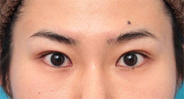 目尻切開,目尻切開+タレ目形成（グラマラスライン）で目を一回り大きくした男性の症例写真の術前術後画像,手術前,mainpic_panda07a.jpg