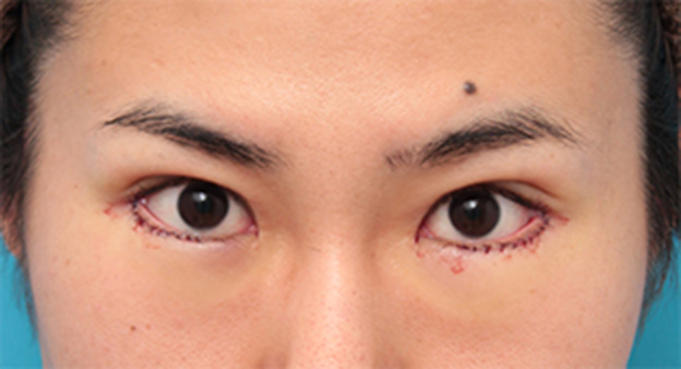 目尻切開,目尻切開+タレ目形成（グラマラスライン）で目を一回り大きくした男性の症例写真の術前術後画像,手術直後,mainpic_panda07b.jpg