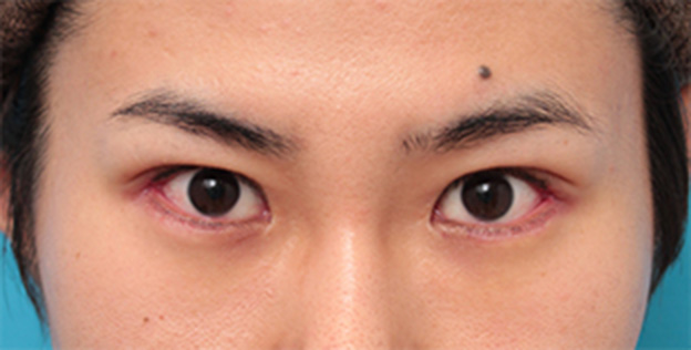 垂れ目（パンダ目）形成（グラマラスライン／下眼瞼下制術）,目尻切開+タレ目形成（グラマラスライン）で目を一回り大きくした男性の症例写真の術前術後画像,1週間後,mainpic_panda07c.jpg