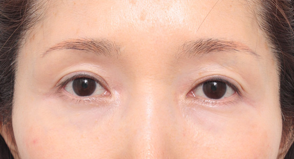 眼瞼下垂（がんけんかすい）,眼瞼下垂（がんけんかすい） 腱膜性眼瞼下垂の50代女性の症例,After,ba_ganken31_a01.jpg