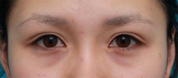 眼瞼下垂（がんけんかすい）,他院で行った切開二重を眼瞼下垂手術で修正し目頭切開も行いハーフっぽい印象になった症例写真,After（メイクなし）,ba_ganken36_b.jpg