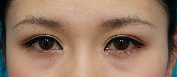 症例写真,他院で行った切開二重を眼瞼下垂手術で修正し目頭切開も行いハーフっぽい印象になった症例写真,After（メイクあり）,