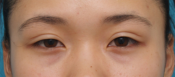 眼瞼下垂（がんけんかすい）,他院で行った切開二重を眼瞼下垂手術で修正し目頭切開も行いハーフっぽい印象になった症例写真,Before,ba_ganken36_b.jpg