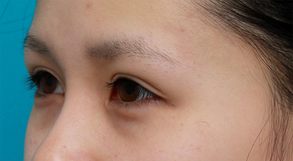 眼瞼下垂（がんけんかすい）,他院で行った切開二重を眼瞼下垂手術で修正し目頭切開も行いハーフっぽい印象になった症例写真,After（メイクなし）,ba_ganken37_b.jpg