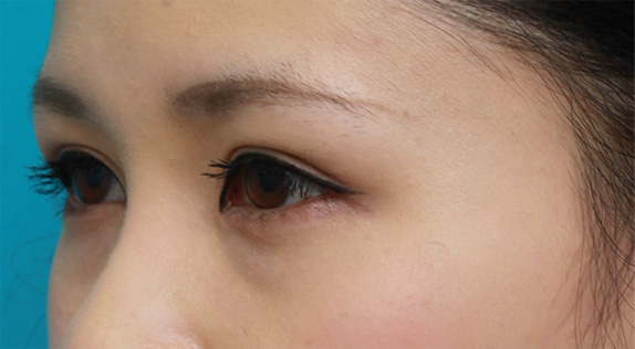 眼瞼下垂（がんけんかすい）,他院で行った切開二重を眼瞼下垂手術で修正し目頭切開も行いハーフっぽい印象になった症例写真,After（メイクあり）,