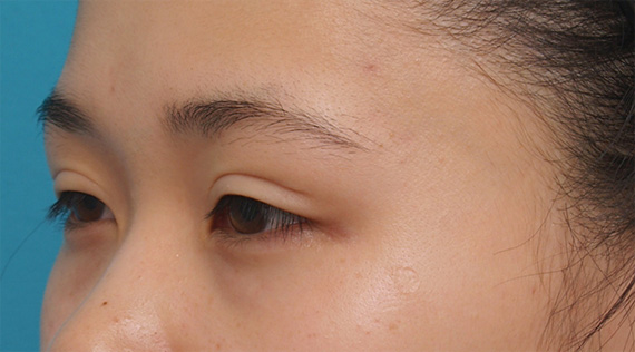 眼瞼下垂（がんけんかすい）,他院で行った切開二重を眼瞼下垂手術で修正し目頭切開も行いハーフっぽい印象になった症例写真,Before,ba_ganken37_b.jpg