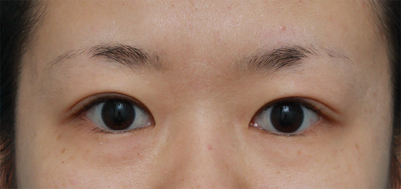 眼瞼下垂（がんけんかすい）,非常に厚ぼったい一重まぶたに対して、大量の脂肪を切除して眼瞼下垂手術を行った症例写真,After（6ヶ月後）,ba_ganken38_a01.jpg