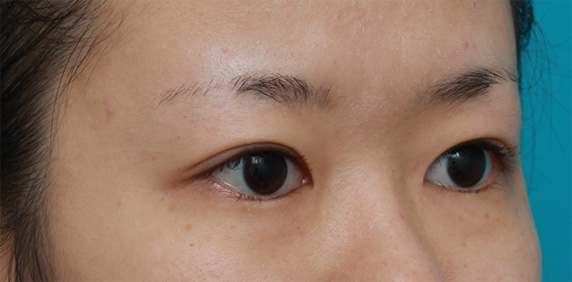 眼瞼下垂（がんけんかすい）,非常に厚ぼったい一重まぶたに対して、大量の脂肪を切除して眼瞼下垂手術を行った症例写真,After（6ヶ月後）,ba_ganken39_b.jpg