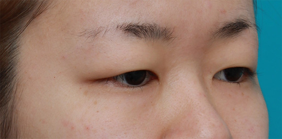眼瞼下垂（がんけんかすい）,非常に厚ぼったい一重まぶたに対して、大量の脂肪を切除して眼瞼下垂手術を行った症例写真,Before,ba_ganken39_b.jpg