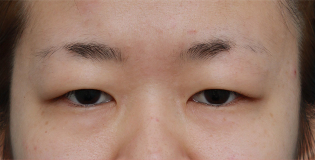 眼瞼下垂（がんけんかすい）,非常に厚ぼったい一重まぶたに対して、大量の脂肪を切除して眼瞼下垂手術を行った症例写真,手術前,mainpic_ganken06a.jpg
