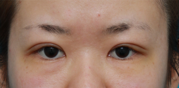 眼瞼下垂（がんけんかすい）,非常に厚ぼったい一重まぶたに対して、大量の脂肪を切除して眼瞼下垂手術を行った症例写真,1週間後,mainpic_ganken06c.jpg