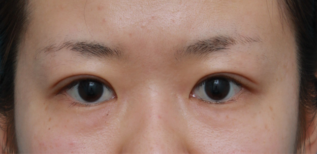 眼瞼下垂（がんけんかすい）,非常に厚ぼったい一重まぶたに対して、大量の脂肪を切除して眼瞼下垂手術を行った症例写真,1ヶ月後,mainpic_ganken06d.jpg