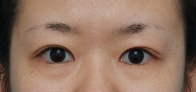 眼瞼下垂（がんけんかすい）,非常に厚ぼったい一重まぶたに対して、大量の脂肪を切除して眼瞼下垂手術を行った症例写真,6ヶ月後,mainpic_ganken06e.jpg
