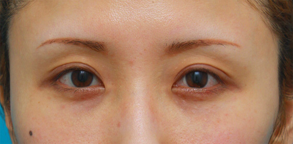 眼瞼下垂（がんけんかすい）,眼瞼下垂手術をして、まぶたの窪みを解消させ、二重を作った症例写真,After（6ヶ月後）,ba_ganken40_a01.jpg