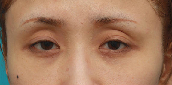 眼瞼下垂（がんけんかすい）,眼瞼下垂手術をして、まぶたの窪みを解消させ、二重を作った症例写真,Before,ba_ganken40_b.jpg