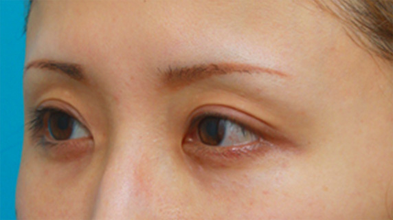 眼瞼下垂（がんけんかすい）,眼瞼下垂手術をして、まぶたの窪みを解消させ、二重を作った症例写真,After（6ヶ月後）,ba_ganken41_b.jpg