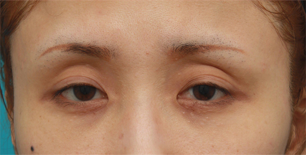 眼瞼下垂（がんけんかすい）,眼瞼下垂手術をして、まぶたの窪みを解消させ、二重を作った症例写真,手術前,mainpic_ganken07a.jpg