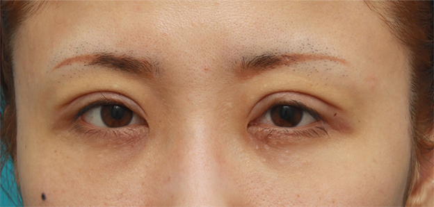眼瞼下垂（がんけんかすい）,眼瞼下垂手術をして、まぶたの窪みを解消させ、二重を作った症例写真,手術直後,mainpic_ganken07b.jpg
