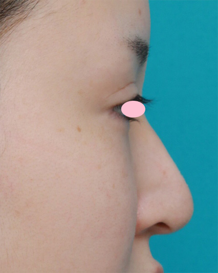 症例写真,鼻尖形成手術でダンゴ鼻を細くした症例写真,After（3ヶ月後）,ba_bisen22_b.jpg