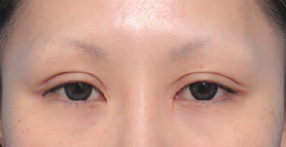 眼瞼下垂（がんけんかすい）,他院で受けた手術の修正（二重まぶた・目もと）,他院で行われた二重まぶた切開法に対し、眼瞼下垂手術で二重の幅を狭く修正した症例写真,Before,ba_ganken42_b.jpg