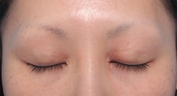 眼瞼下垂（がんけんかすい）,他院で行われた二重まぶた切開法に対し、眼瞼下垂手術で二重の幅を狭く修正した症例写真,Before,ba_ganken43_b.jpg