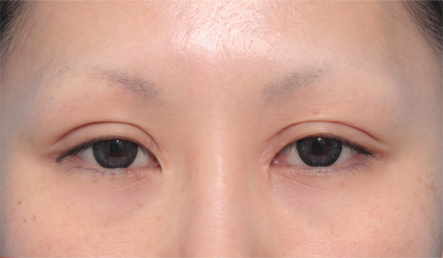 眼瞼下垂（がんけんかすい）,他院で行われた二重まぶた切開法に対し、眼瞼下垂手術で二重の幅を狭く修正した症例写真,手術前,mainpic_ganken08a.jpg