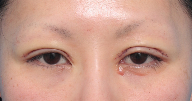 症例写真,他院で行われた二重まぶた切開法に対し、眼瞼下垂手術で二重の幅を狭く修正した症例写真,手術直後,mainpic_ganken08b.jpg