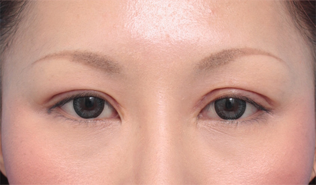 眼瞼下垂（がんけんかすい）,他院で行われた二重まぶた切開法に対し、眼瞼下垂手術で二重の幅を狭く修正した症例写真,1週間後,mainpic_ganken08c.jpg