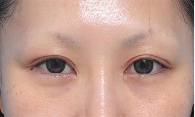 他院で受けた手術の修正（二重まぶた・目もと）,他院で行われた二重まぶた切開法に対し、眼瞼下垂手術で二重の幅を狭く修正した症例写真,4ヶ月後,mainpic_ganken08d.jpg