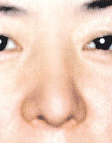症例写真,鼻尖形成（鼻尖縮小・だんご鼻修正）の症例写真,After,ba_bisen08_b.jpg