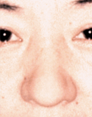 症例写真,鼻尖形成（鼻尖縮小・だんご鼻修正）の症例写真,Before,ba_bisen08_b.jpg