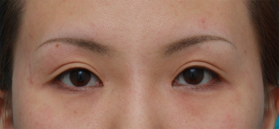 眼瞼下垂（がんけんかすい）,目頭切開+眼瞼下垂手術の症例写真,After（メイクなし）,ba_ganken44_b.jpg