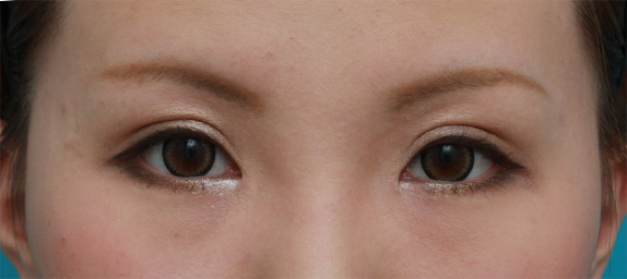 眼瞼下垂（がんけんかすい）,目頭切開+眼瞼下垂手術の症例写真,After（メイクあり）<br/>
（6ヶ月後）,