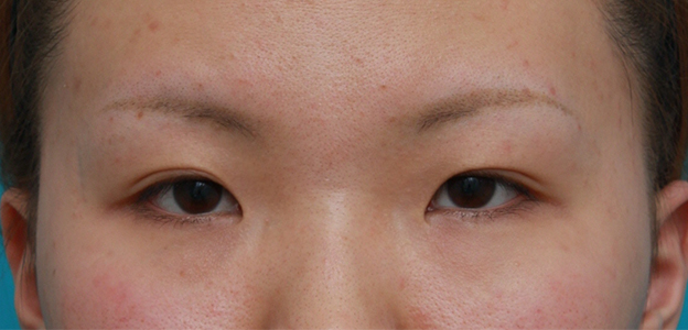 症例写真,目頭切開+眼瞼下垂手術の症例写真,手術前,mainpic_ganken09a.jpg