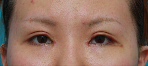 眼瞼下垂（がんけんかすい）,目頭切開+眼瞼下垂手術の症例写真,1週間後,mainpic_ganken09c.jpg