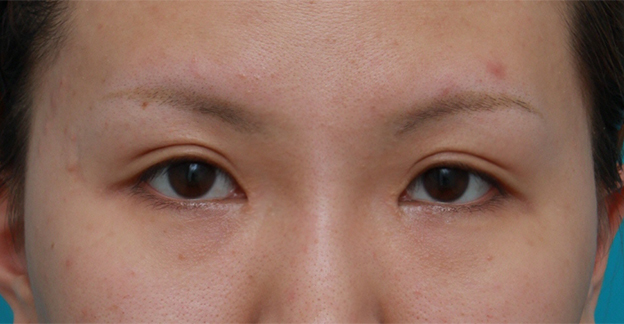 眼瞼下垂（がんけんかすい）,目頭切開+眼瞼下垂手術の症例写真,2ヶ月後,mainpic_ganken09d.jpg
