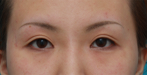 眼瞼下垂（がんけんかすい）,目頭切開+眼瞼下垂手術の症例写真,6ヶ月後,メイクなし,mainpic_ganken09e.jpg