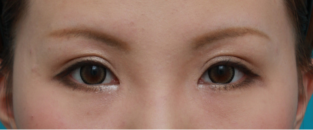 眼瞼下垂（がんけんかすい）,目頭切開+眼瞼下垂手術の症例写真,6ヶ月後,メイクあり,mainpic_ganken09f.jpg