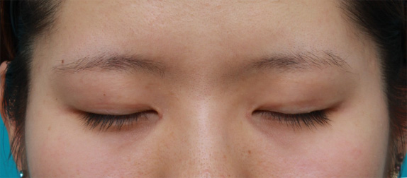 目頭切開,目頭切開+眼瞼下垂手術で小さい目を一回り大きくした症例写真,After（目を閉じた状態）<br/>
（6ヶ月後）,