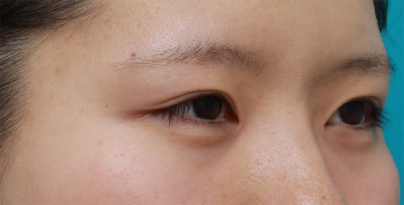眼瞼下垂（がんけんかすい）,目頭切開+眼瞼下垂手術で小さい目を一回り大きくした症例写真,After（6ヶ月後）,ba_ganken46_b.jpg