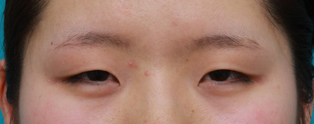 眼瞼下垂（がんけんかすい）,目頭切開+眼瞼下垂手術で小さい目を一回り大きくした症例写真,手術前,mainpic_ganken10a.jpg