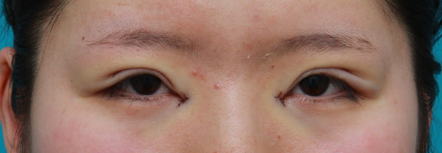 眼瞼下垂（がんけんかすい）,目頭切開+眼瞼下垂手術で小さい目を一回り大きくした症例写真,手術直後,mainpic_ganken10b.jpg