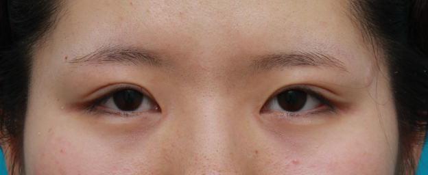 眼瞼下垂（がんけんかすい）,目頭切開+眼瞼下垂手術で小さい目を一回り大きくした症例写真,2ヶ月後,mainpic_ganken10d.jpg