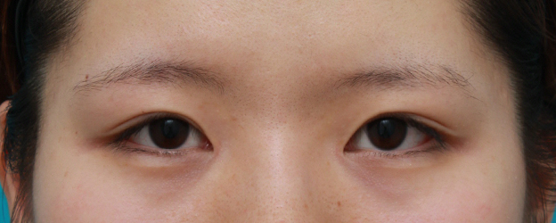 症例写真,目頭切開+眼瞼下垂手術で小さい目を一回り大きくした症例写真,6ヶ月後,目を開けた状態 ,mainpic_ganken10e.jpg