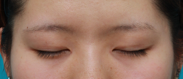 眼瞼下垂（がんけんかすい）,目頭切開+眼瞼下垂手術で小さい目を一回り大きくした症例写真,6ヶ月後,目を閉じた状態,mainpic_ganken10f.jpg