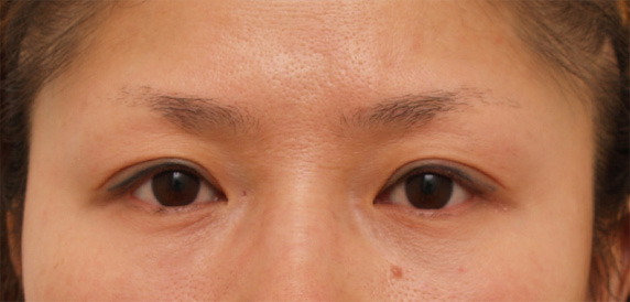症例写真,眼瞼下垂（がんけんかすい） 左目が三重になっていた30代女性の症例,After（6ヶ月後）,ba_ganken47_b.jpg
