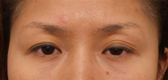 眼瞼下垂（がんけんかすい）,眼瞼下垂（がんけんかすい） 左目が三重になっていた30代女性の症例,Before,ba_ganken47_b.jpg