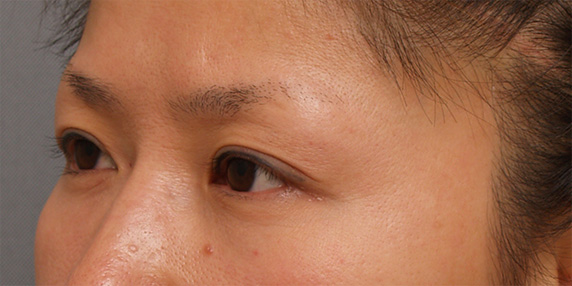 症例写真,眼瞼下垂（がんけんかすい） 左目が三重になっていた30代女性の症例,After（6ヶ月後）,ba_ganken48_b.jpg